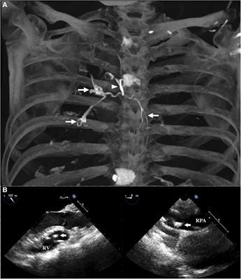 Case report: Open-heart removal for a cement embolism formed 10 years ago in the right ventricle and pulmonary artery